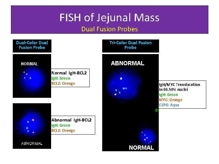 FISH of Jejunal Mass Dual Fusion Probes Dual-Color Dual Fusion Probe Tri-Color Dual Fusion