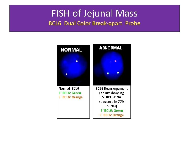 FISH of Jejunal Mass BCL 6 Dual Color Break-apart Probe Normal BCL 6 3`