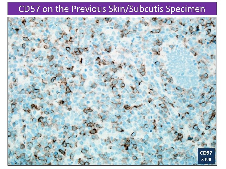 CD 57 on the Previous Skin/Subcutis Specimen CD 57 X 400 