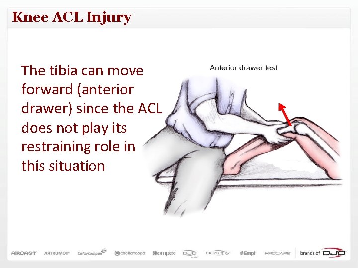 Knee ACL Injury The tibia can move forward (anterior drawer) since the ACL does