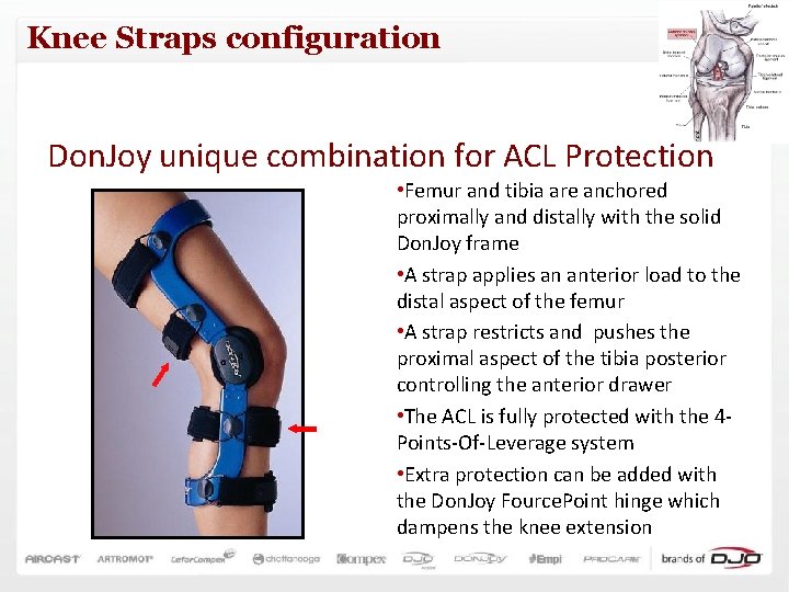 Knee Straps configuration Don. Joy unique combination for ACL Protection • Femur and tibia