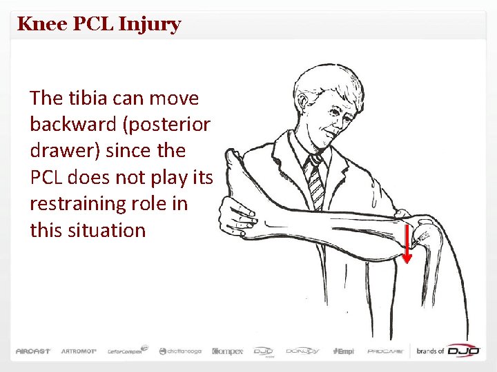 Knee PCL Injury The tibia can move backward (posterior drawer) since the PCL does