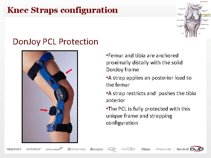 Knee Straps configuration Don. Joy PCL Protection • Femur and tibia are anchored proximally