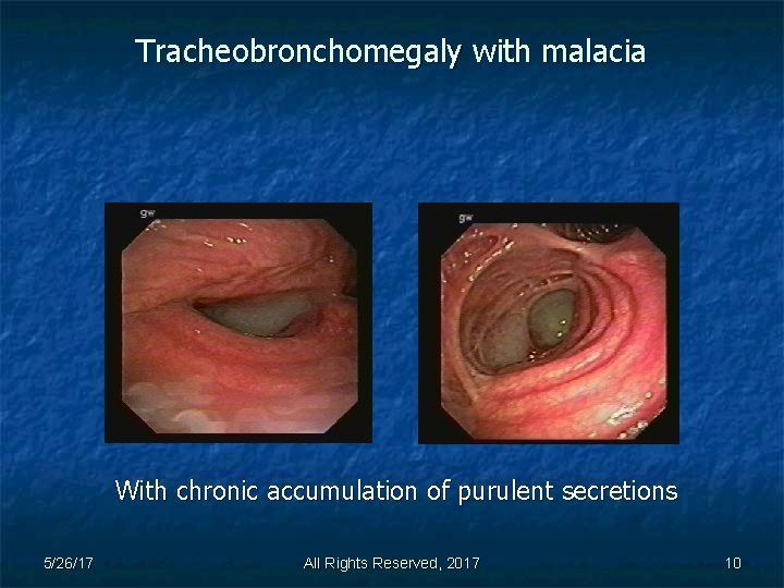 Tracheobronchomegaly with malacia With chronic accumulation of purulent secretions 5/26/17 All Rights Reserved, 2017