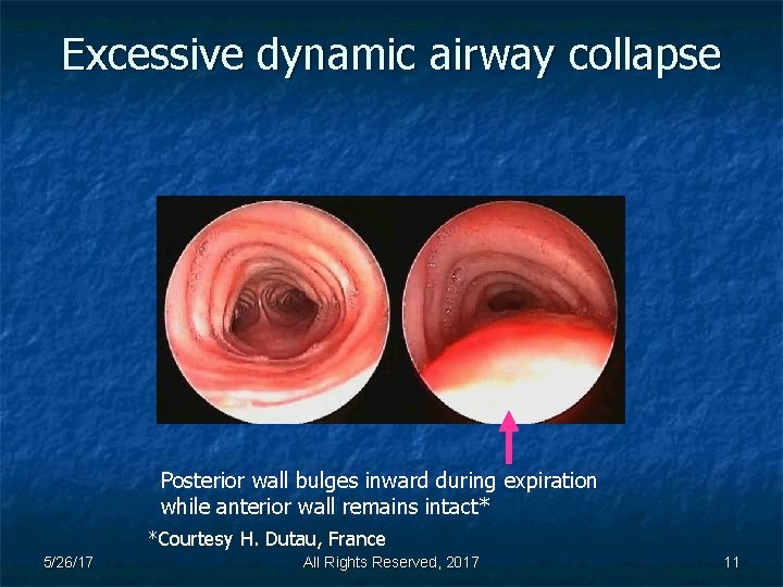 Excessive dynamic airway collapse Posterior wall bulges inward during expiration while anterior wall remains