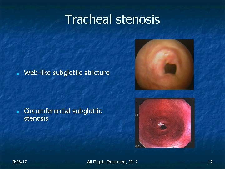 Tracheal stenosis ■ ■ Web-like subglottic stricture Circumferential subglottic stenosis 5/26/17 All Rights Reserved,