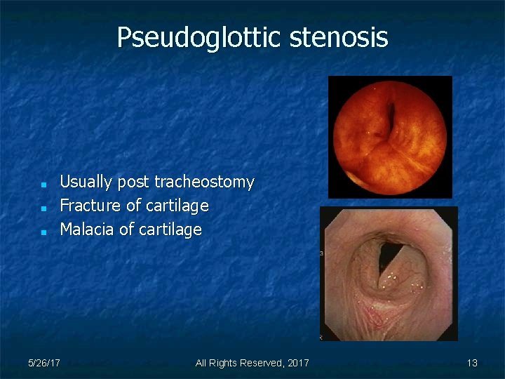 Pseudoglottic stenosis ■ ■ ■ Usually post tracheostomy Fracture of cartilage Malacia of cartilage