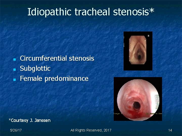 Idiopathic tracheal stenosis* * ■ ■ ■ Circumferential stenosis Subglottic Female predominance *Courtesy J.