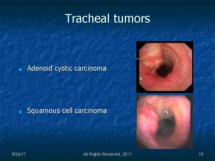 Tracheal tumors ■ Adenoid cystic carcinoma ■ Squamous cell carcinoma 5/26/17 All Rights Reserved,