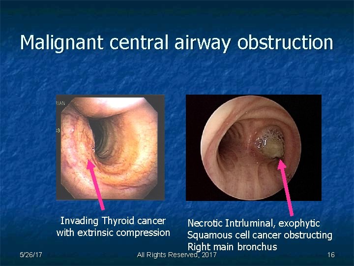 Malignant central airway obstruction Invading Thyroid cancer with extrinsic compression 5/26/17 Necrotic Intrluminal, exophytic
