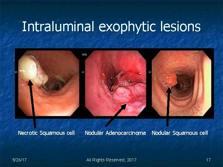 Intraluminal exophytic lesions Necrotic Squamous cell 5/26/17 Nodular Adenocarcinoma Nodular Squamous cell All Rights