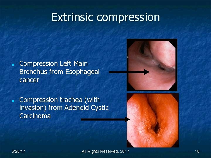 Extrinsic compression ■ ■ Compression Left Main Bronchus from Esophageal cancer Compression trachea (with