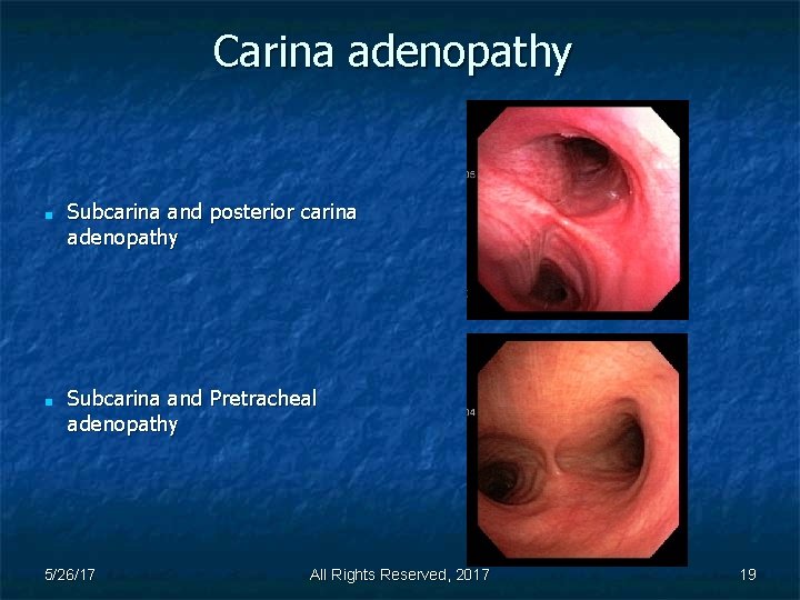 Carina adenopathy ■ ■ Subcarina and posterior carina adenopathy Subcarina and Pretracheal adenopathy 5/26/17