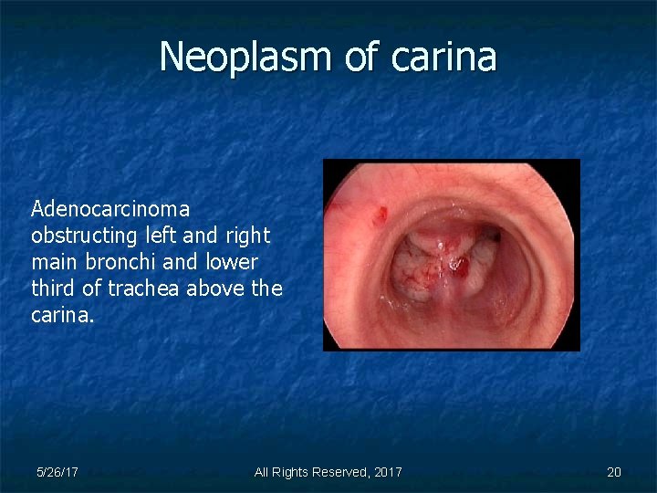Neoplasm of carina Adenocarcinoma obstructing left and right main bronchi and lower third of