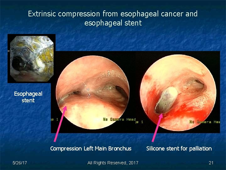 Extrinsic compression from esophageal cancer and esophageal stent Esophageal stent Compression Left Main Bronchus