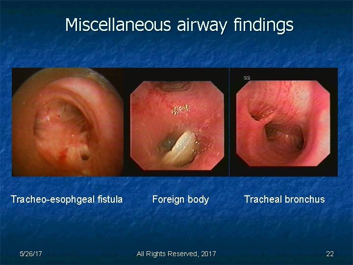 Miscellaneous airway findings Tracheo-esophgeal fistula 5/26/17 Foreign body All Rights Reserved, 2017 Tracheal bronchus