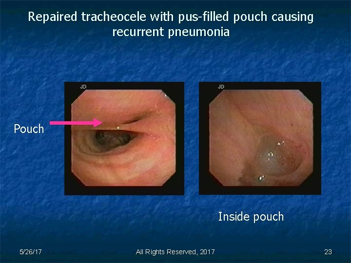 Repaired tracheocele with pus-filled pouch causing recurrent pneumonia Pouch Inside pouch 5/26/17 All Rights