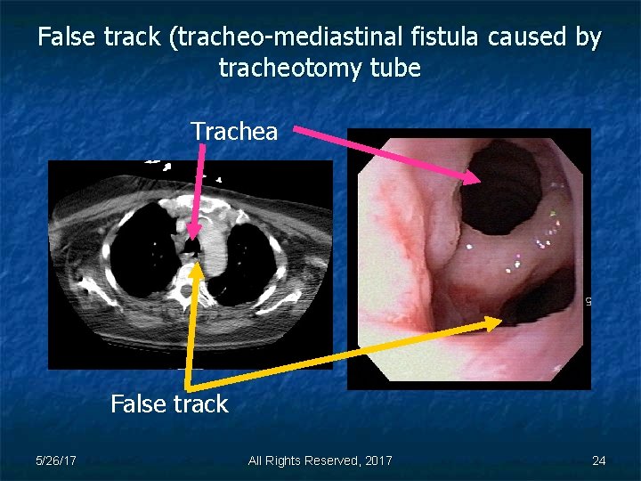 False track (tracheo-mediastinal fistula caused by tracheotomy tube Trachea False track 5/26/17 All Rights