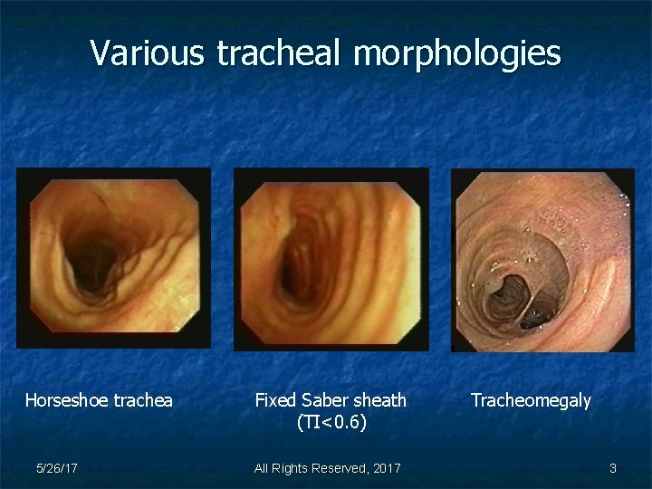 Various tracheal morphologies Horseshoe trachea 5/26/17 Fixed Saber sheath (TI<0. 6) All Rights Reserved,