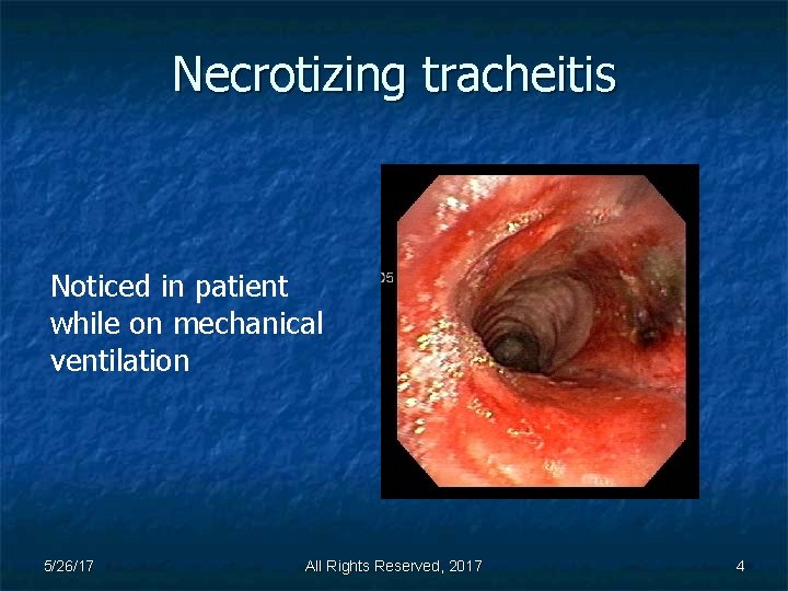 Necrotizing tracheitis Noticed in patient while on mechanical ventilation 5/26/17 All Rights Reserved, 2017