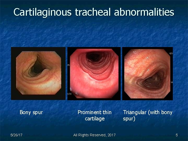 Cartilaginous tracheal abnormalities Bony spur 5/26/17 Prominent thin cartilage All Rights Reserved, 2017 Triangular