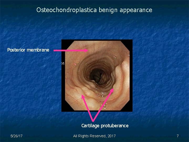 Osteochondroplastica benign appearance Posterior membrane Cartilage protuberance 5/26/17 All Rights Reserved, 2017 7 