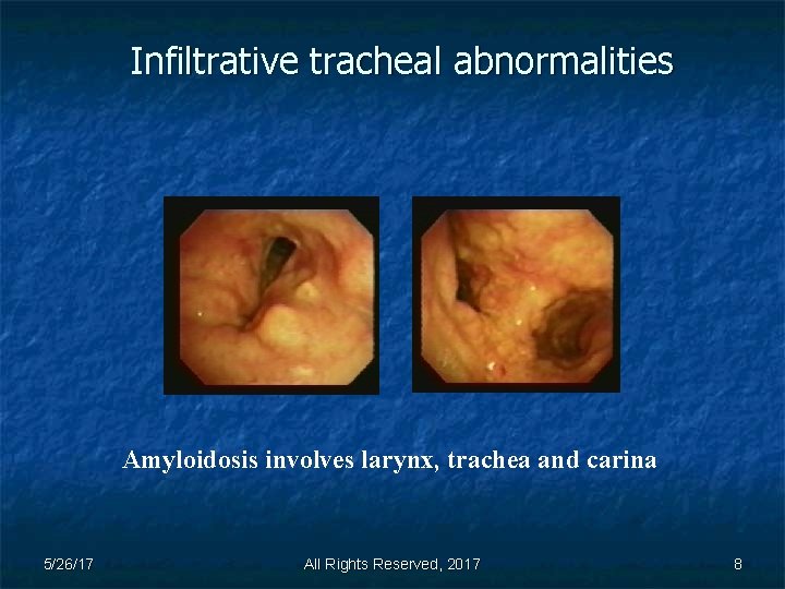 Infiltrative tracheal abnormalities Amyloidosis involves larynx, trachea and carina 5/26/17 All Rights Reserved, 2017