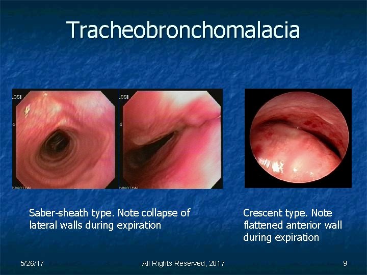 Tracheobronchomalacia Saber-sheath type. Note collapse of lateral walls during expiration 5/26/17 All Rights Reserved,