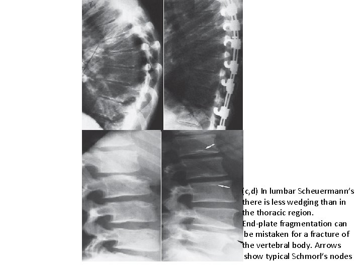 (c, d) In lumbar Scheuermann’s there is less wedging than in the thoracic region.