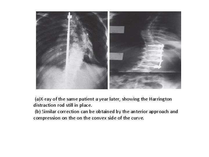 (a)X-ray of the same patient a year later, showing the Harrington distraction rod still