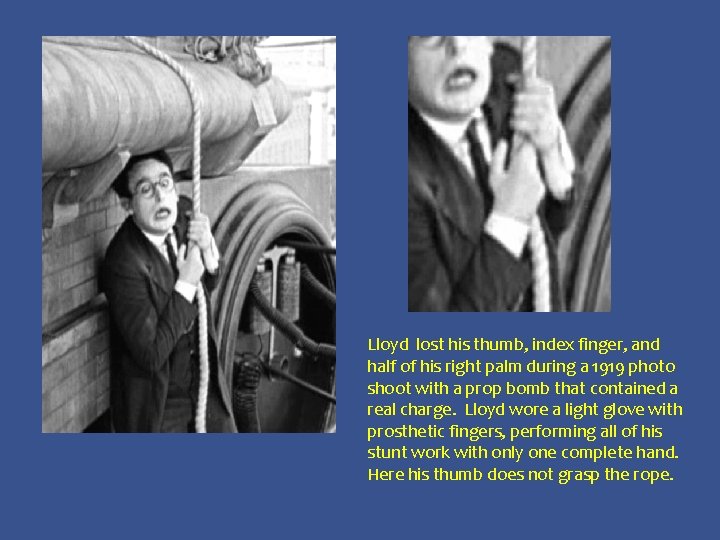 Lloyd lost his thumb, index finger, and half of his right palm during a