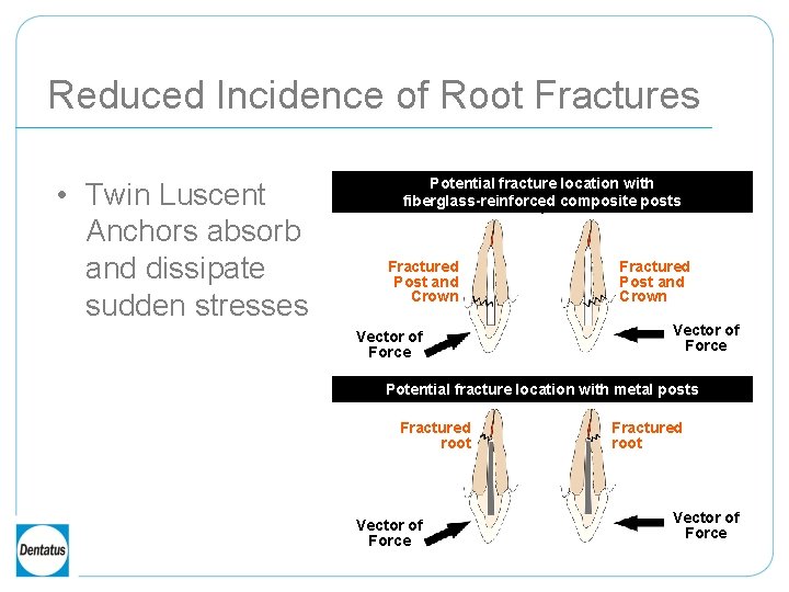 Reduced Incidence of Root Fractures • Twin Luscent Anchors absorb and dissipate sudden stresses