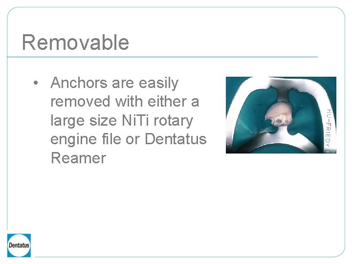 Removable • Anchors are easily removed with either a large size Ni. Ti rotary