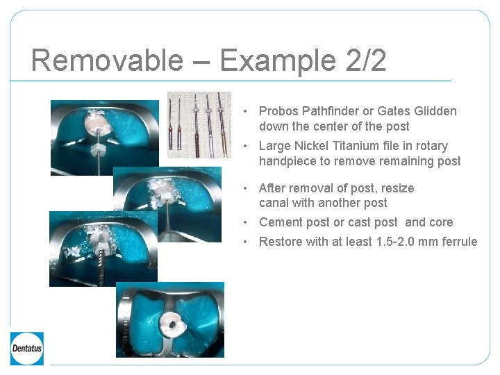 Removable – Example 2/2 • Probos Pathfinder or Gates Glidden down the center of