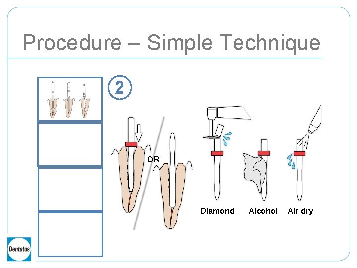 Procedure – Simple Technique 2 OR Diamond Alcohol Air dry 