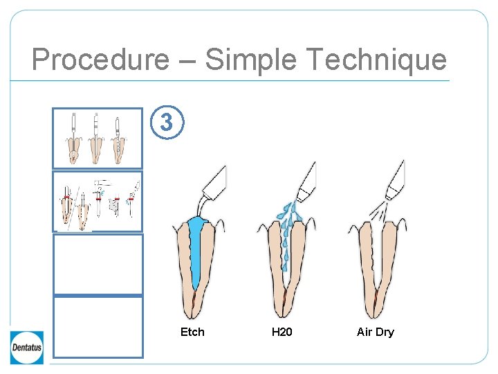 Procedure – Simple Technique 3 Etch H 20 Air Dry 