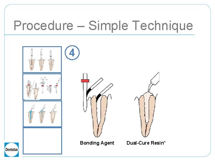 Procedure – Simple Technique 4 Bonding Agent Dual-Cure Resin* 