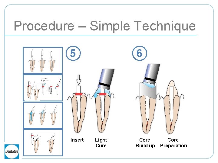 Procedure – Simple Technique 5 Insert 6 Light Cure Core Build up Core Preparation
