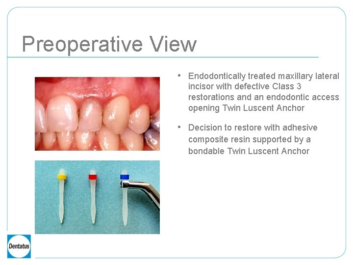 Preoperative View • Endodontically treated maxillary lateral incisor with defective Class 3 restorations and