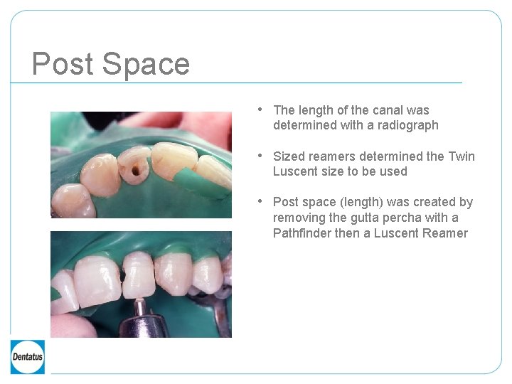 Post Space • The length of the canal was determined with a radiograph •