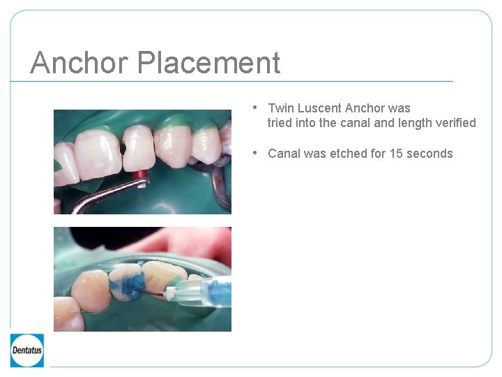 Anchor Placement • Twin Luscent Anchor was tried into the canal and length verified