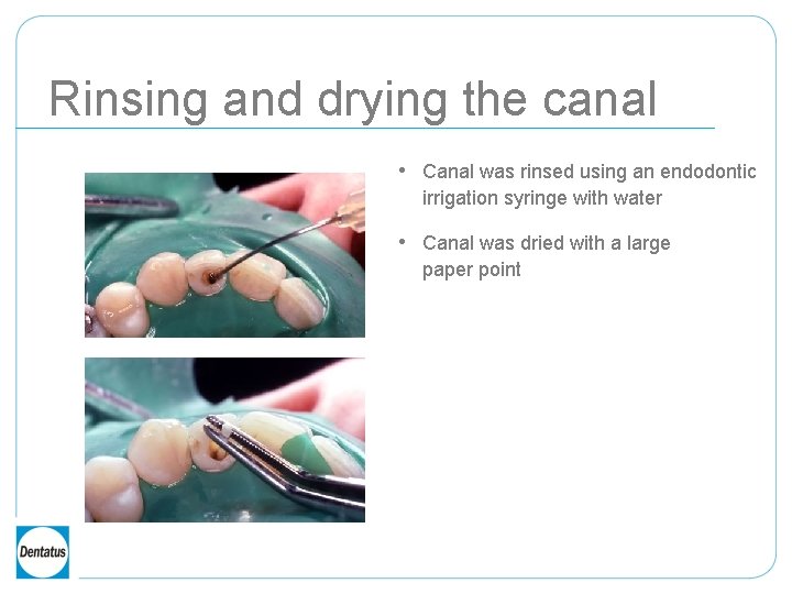 Rinsing and drying the canal • Canal was rinsed using an endodontic irrigation syringe