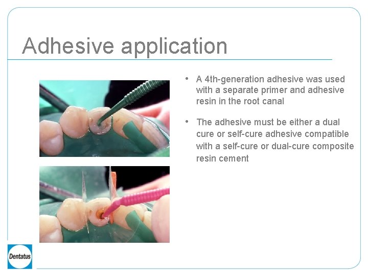 Adhesive application • A 4 th-generation adhesive was used with a separate primer and