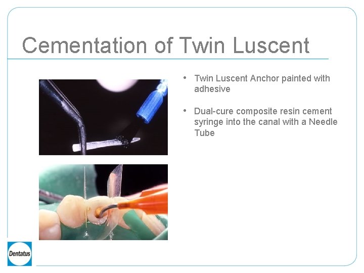 Cementation of Twin Luscent • Twin Luscent Anchor painted with adhesive • Dual-cure composite