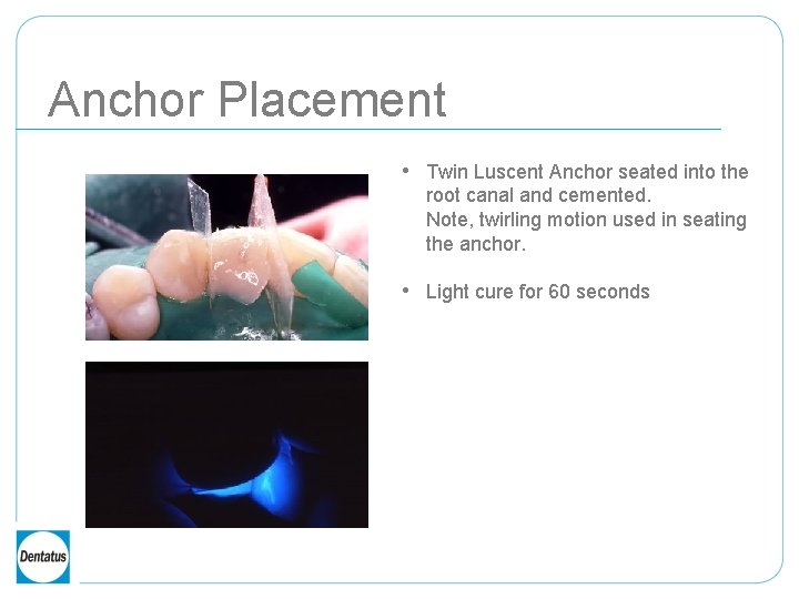 Anchor Placement • Twin Luscent Anchor seated into the root canal and cemented. Note,