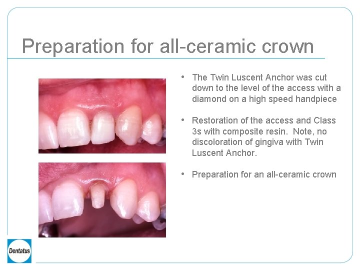 Preparation for all-ceramic crown • The Twin Luscent Anchor was cut down to the