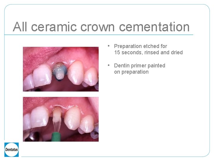 All ceramic crown cementation • Preparation etched for 15 seconds, rinsed and dried •