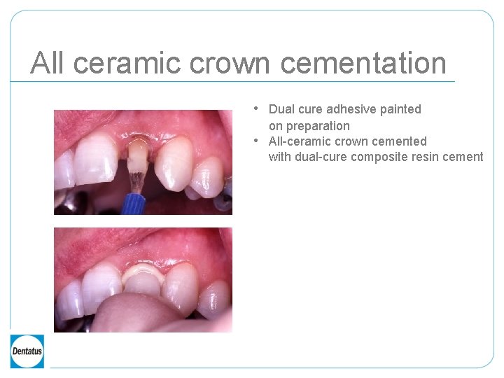 All ceramic crown cementation • Dual cure adhesive painted • on preparation All-ceramic crown