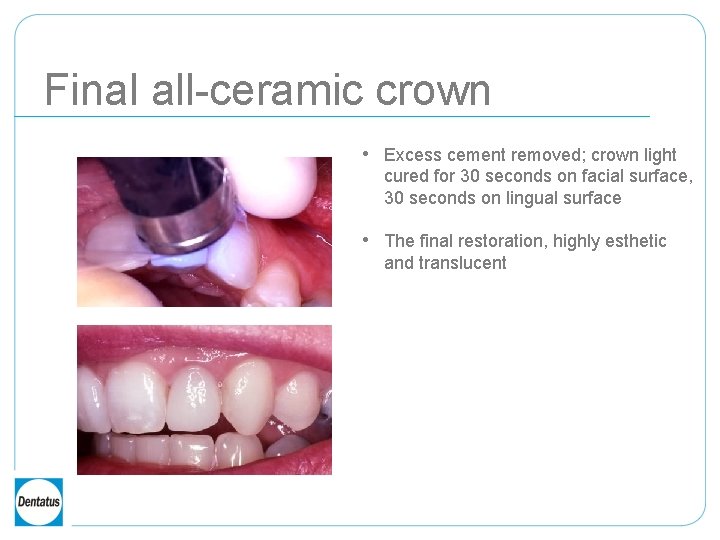 Final all-ceramic crown • Excess cement removed; crown light cured for 30 seconds on
