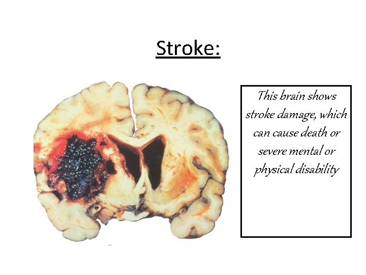 Stroke: This brain shows stroke damage, which can cause death or severe mental or